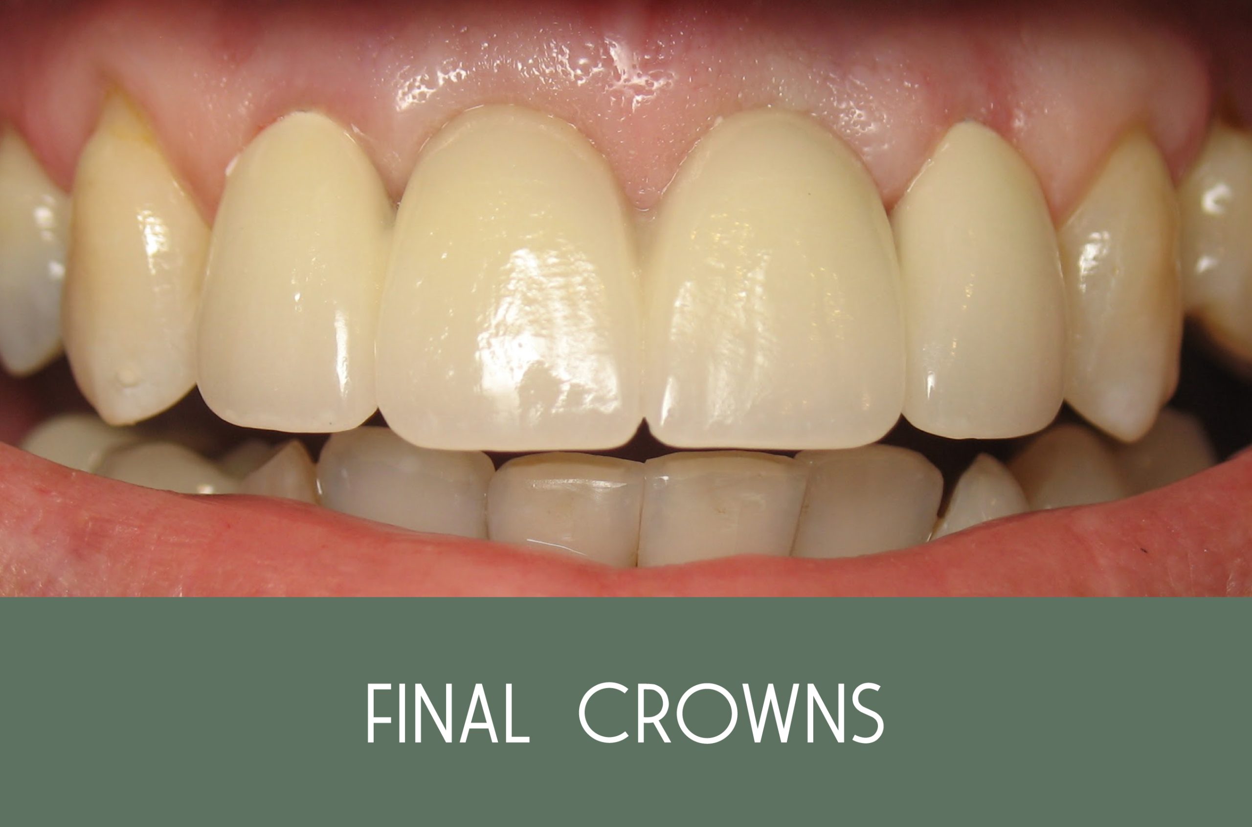 FINALCROWNS