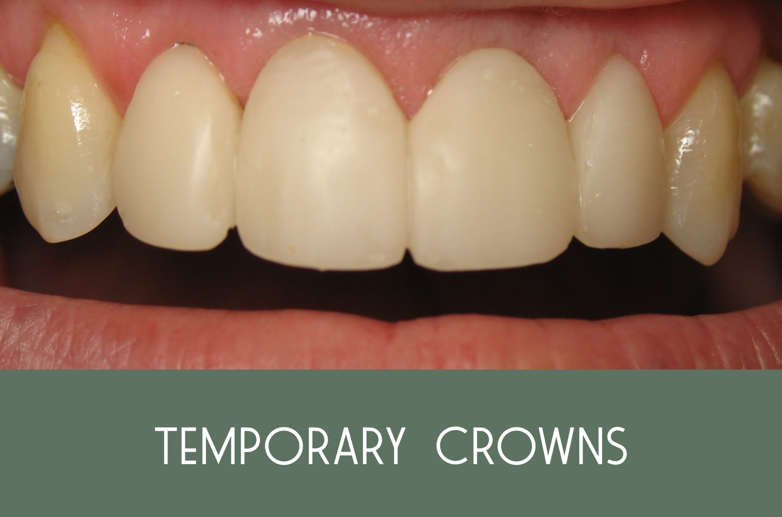 TemporaryCrowns